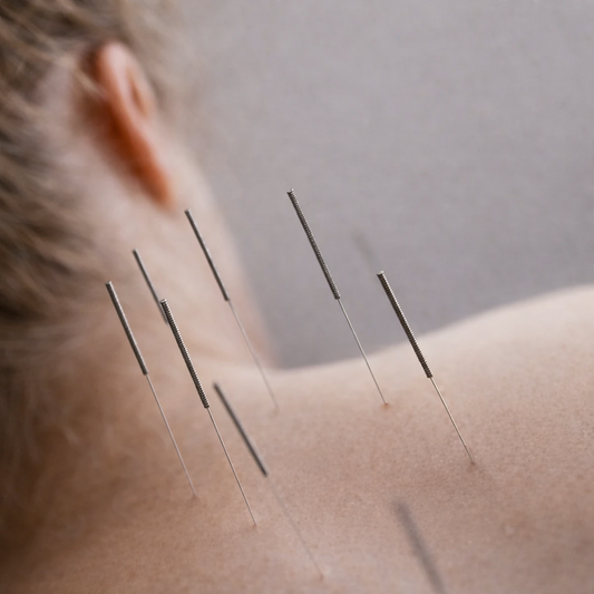 Acupuncture at the Spa: Ancient Techniques for Modern Wellness