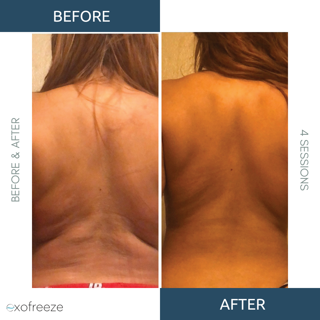 Freezer Botox Exofreeze – Bella Derma Boca Spa